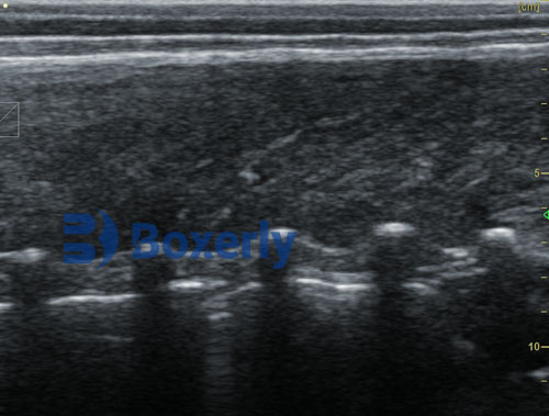 What is Back Fat Thickness in Ultrasound?(图6)