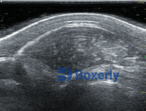 What is Back Fat Thickness in Ultrasound?(图7)